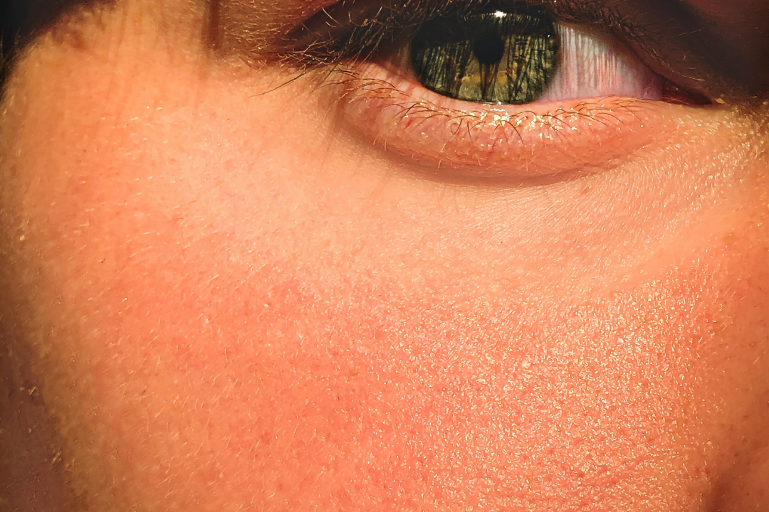 Living With Rosacea