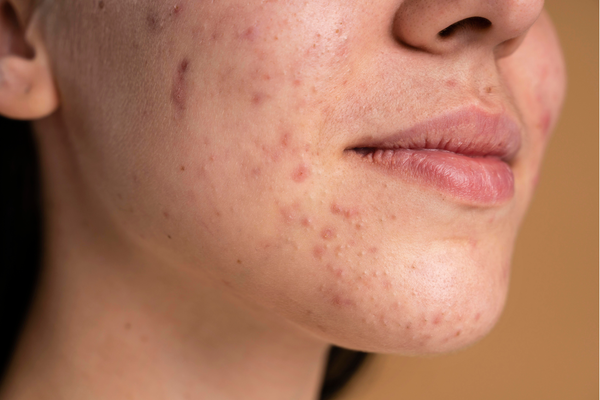 Hormonal Acne Breakouts: A Simple Skincare Routine for Clearer Skin