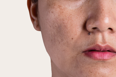 hyperpigmentation dark spots