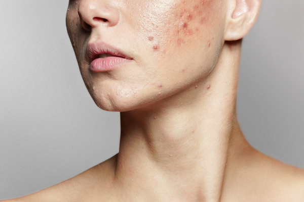 Does Niacinamide Work for Acne-Prone Skin? What to Know Before You Begin