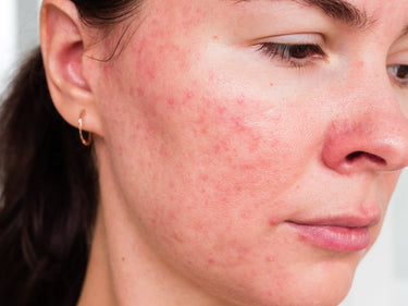 cheek acne