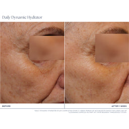 Before-and-after skin comparison of an older woman's face, showing visible wrinkles and sun damage on the left ('BEFORE') and smoother, more hydrated skin on the right ('AFTER 1 WEEK'). The eyes are obscured with rectangular privacy blocks, and the top and bottom text read 'Daily Dynamic Hydrator'.