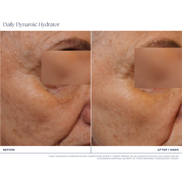 Before-and-after skin comparison of an older woman's face, showing visible wrinkles and sun damage on the left ('BEFORE') and smoother, more hydrated skin on the right ('AFTER 1 WEEK'). The eyes are obscured with rectangular privacy blocks, and the top and bottom text read 'Daily Dynamic Hydrator'.