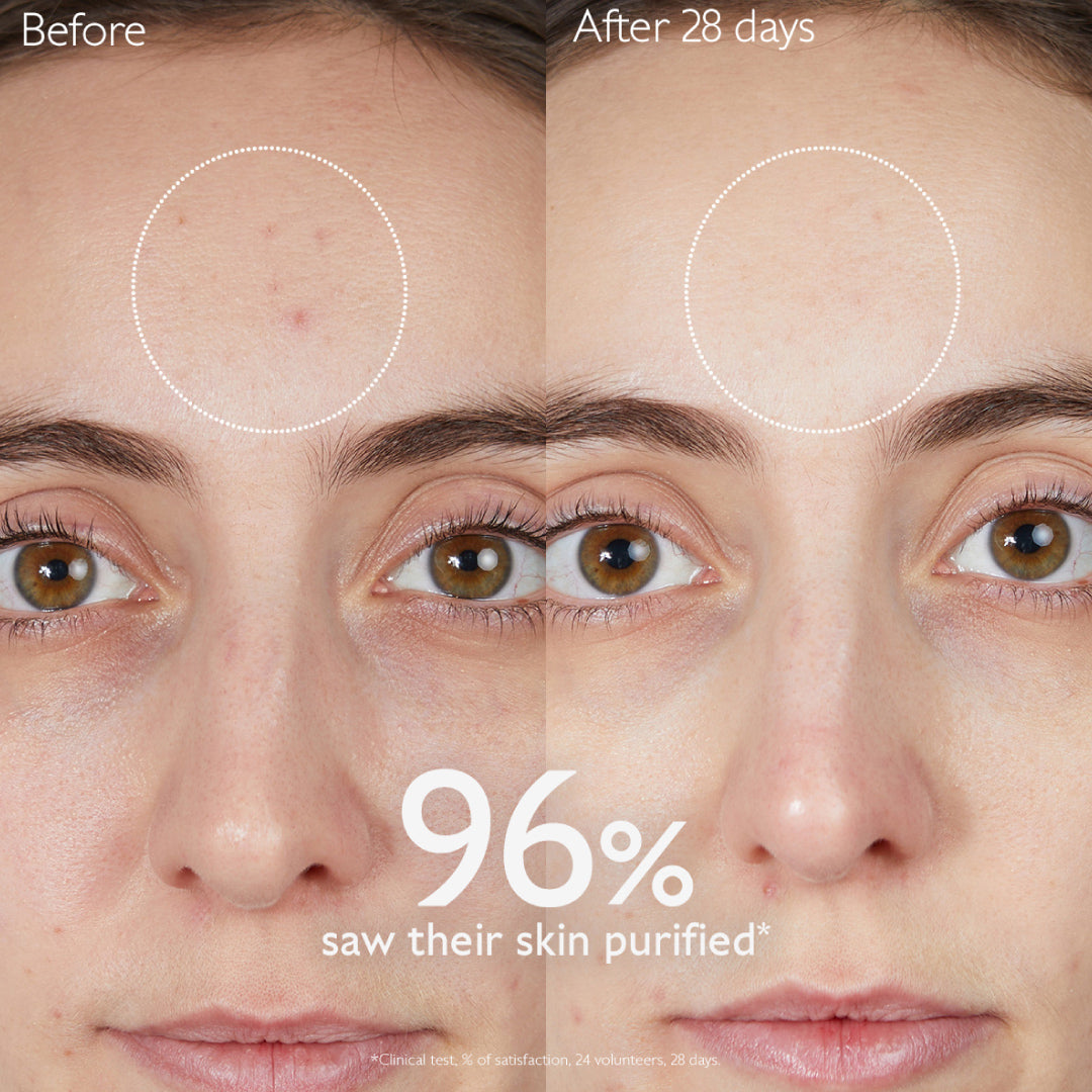Before and after comparison of a woman's face with text indicating skin purification results.