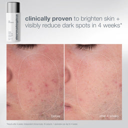 Dermalogica Skin Injector acne treatment bottle shown above a before-and-after comparison of facial skin texture and dark spots on the nose area, with marketing text stating clinically proven to brighten skin and reduce dark spots in 4 weeks.