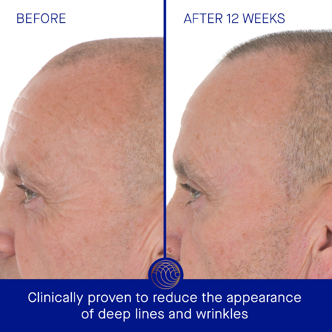 Before and after comparison of a man's face with text indicating clinical provenance for reducing deep lines and wrinkles.