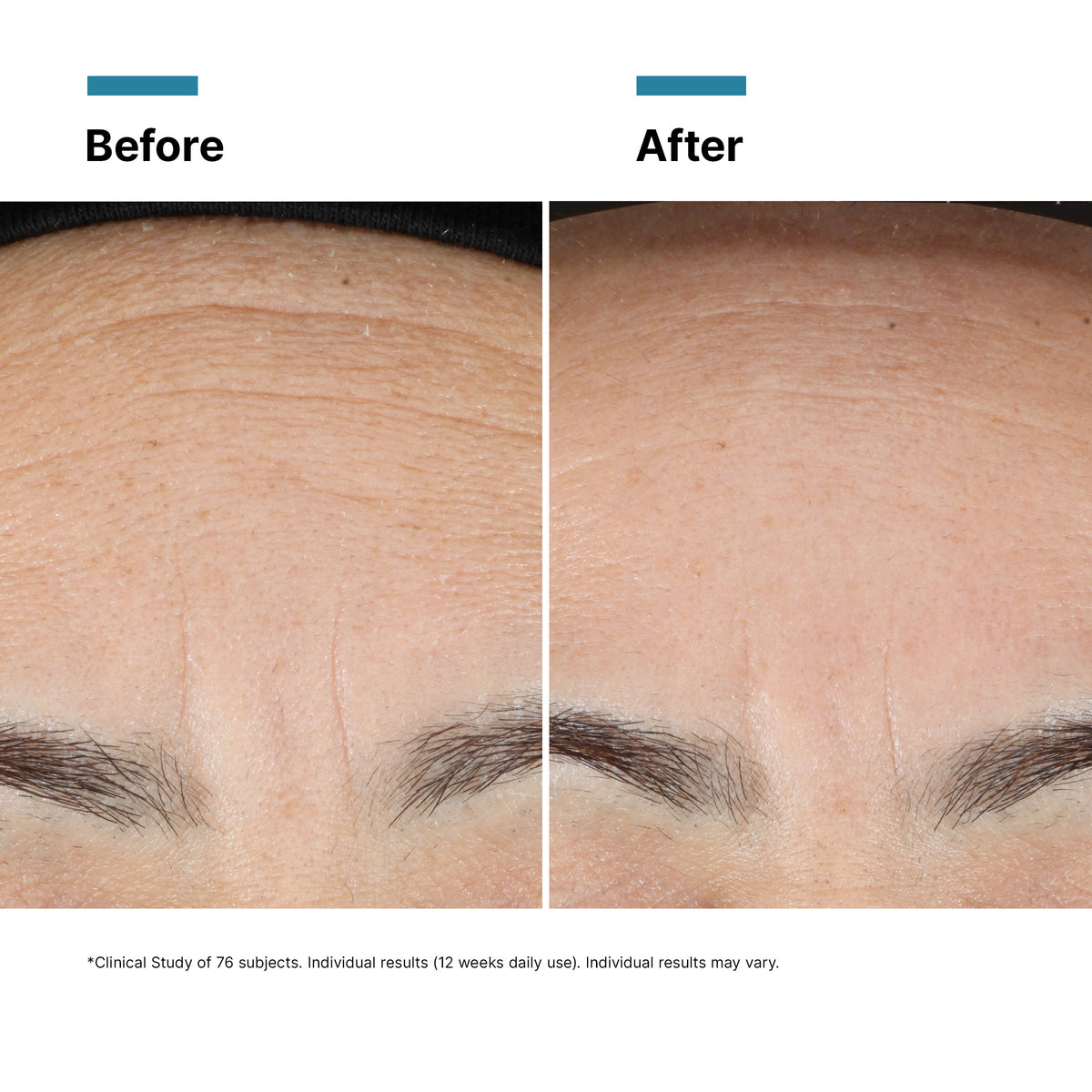 Before and after comparison of skin texture on a forehead.