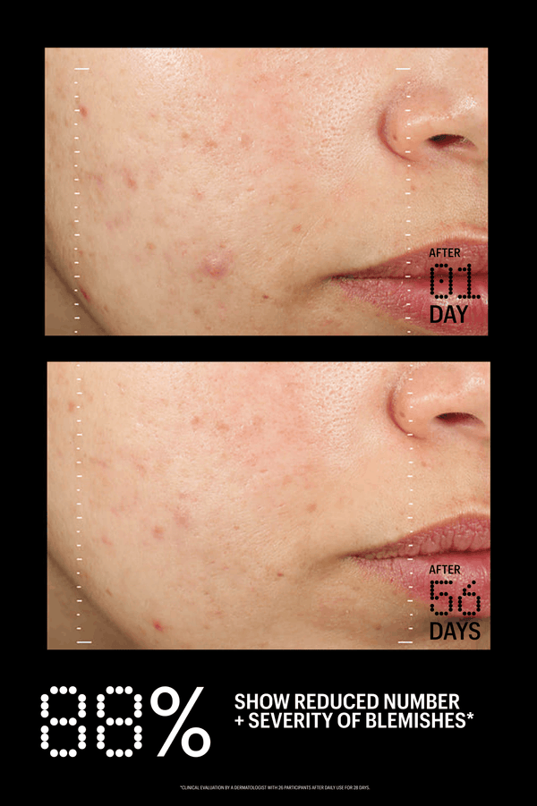Before and after comparison of acne treatment on a person's face with text indicating improvement over 56 days.