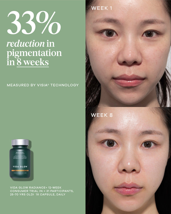 Before and after comparison of a woman's face with text about 33% reduction in pigmentation using Vida Glow product.