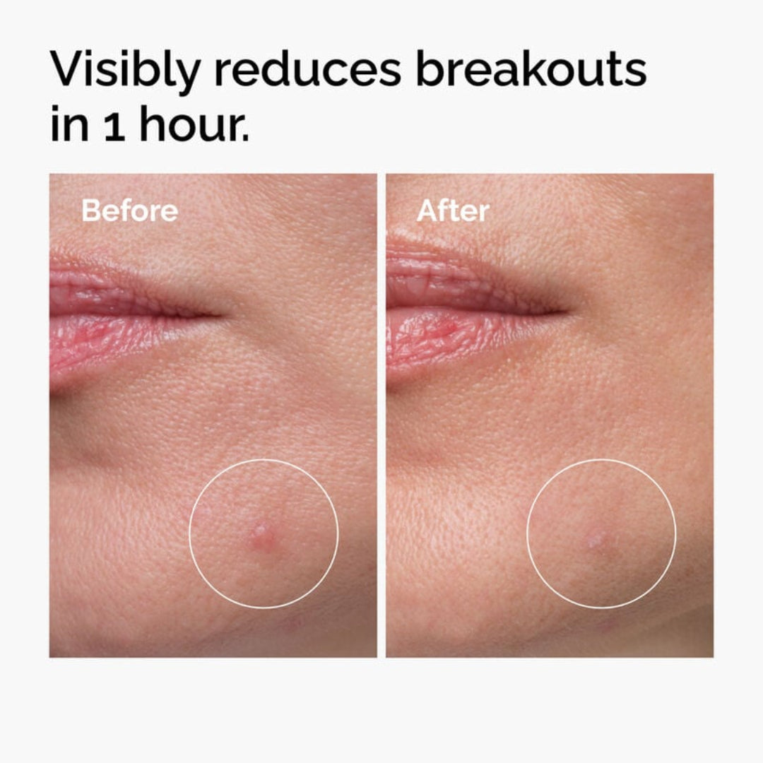 Before and after comparison of skin with a pimple, showing reduction in one hour.